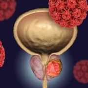 prostat kanseri belirtileri