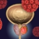 Prostat Kanseri Risk Faktörleri Nelerdir? 20 prostat kanseri belirtileri